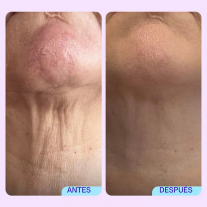 ADIÓS A LA FLACIDEZ Y LAS ARRUGAS DEL CUELLO Y ESCOTE