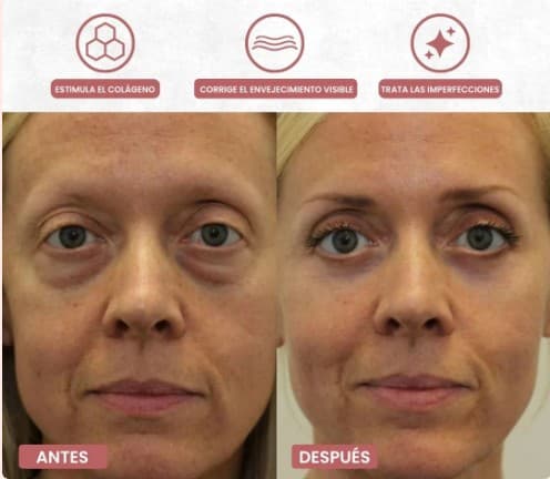 Auralift - Adiós bolsas y ojeras en 2 semanas